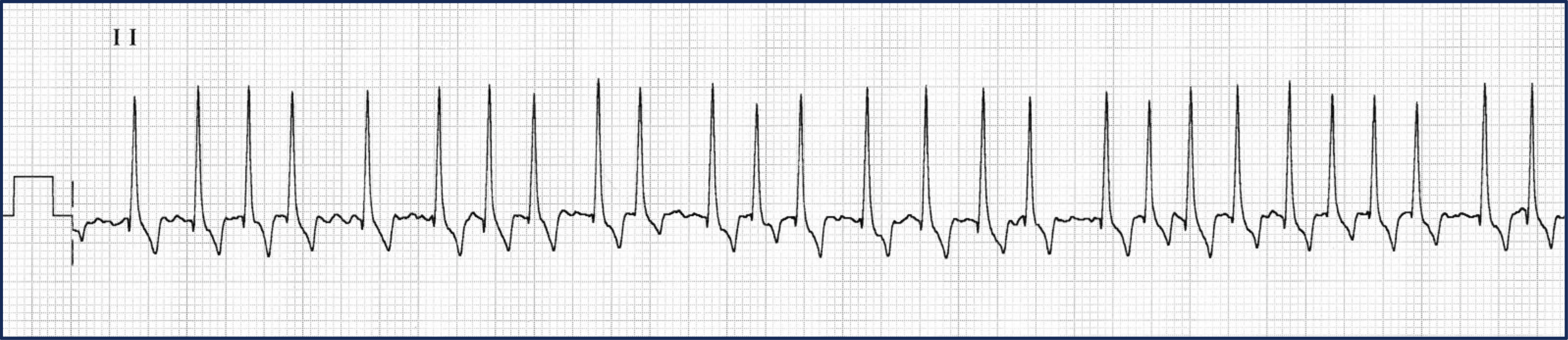 Figure 1: Lead II ECG. Irregularly irregular rhythm consistent with atrial fibrillation.