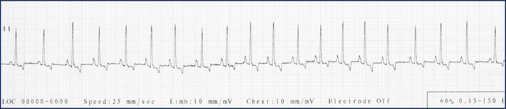 Figure 2: Lead II ECG. Regularly irregular rhythm indicative of vagal influence on heart rhythm.