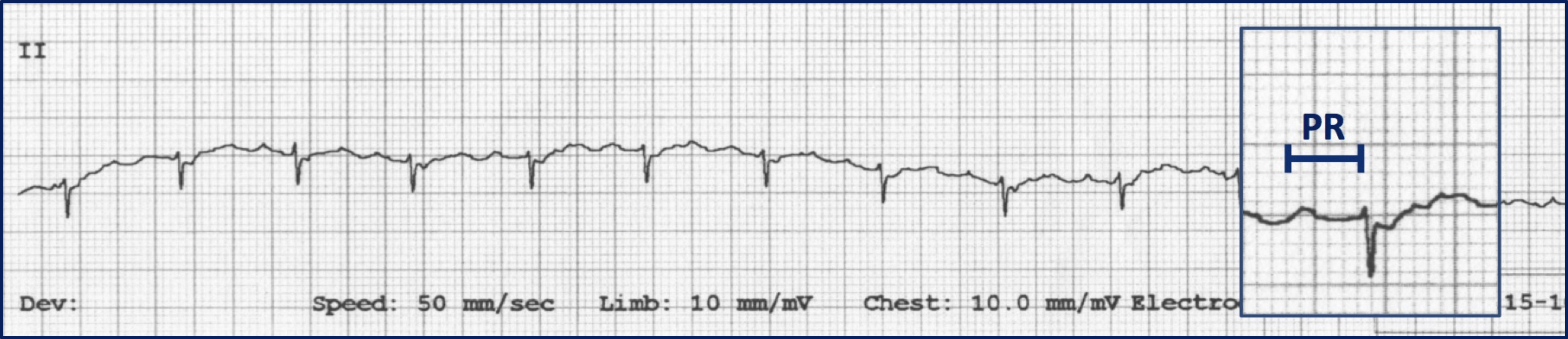 Fig 1: Lead II ECG in a cat showing overall negative QRS complex (decreased R-wave amplitude, prominent S-wave) consistent with a ventricular conduction disturbance. Prolonged PR interval (inset) indicates 1st degree atrioventricular block. Both findings suggest the possibility of cardiomyopathy.