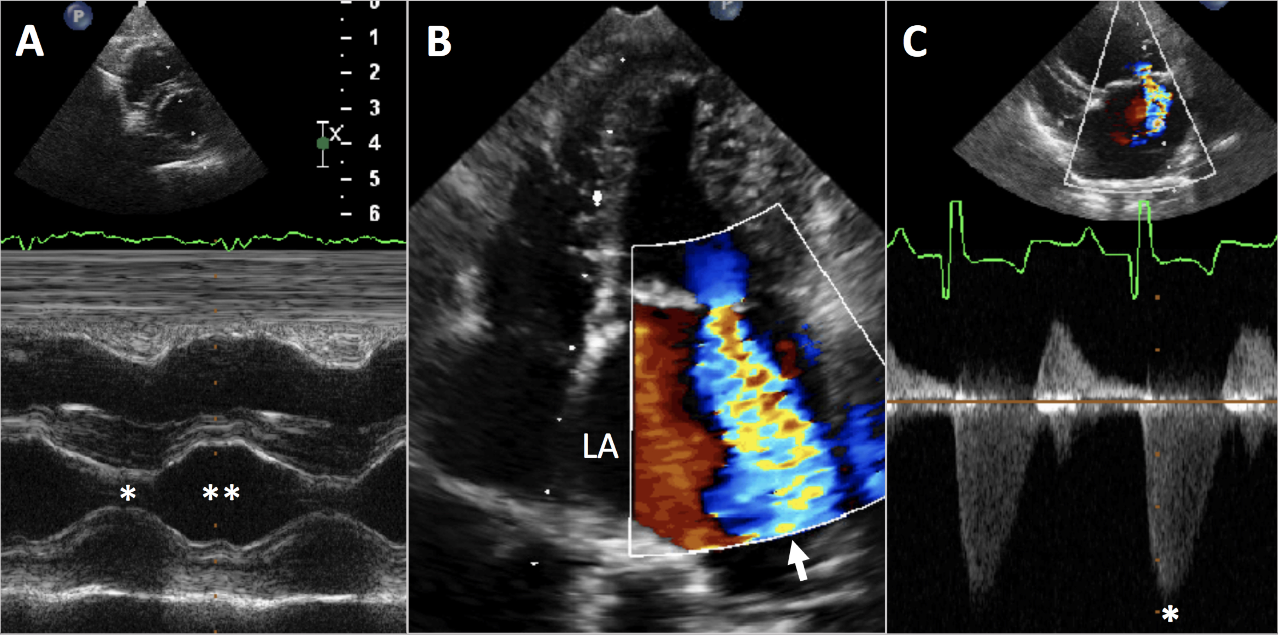 Figure 1: (A) M-mode imaging across left ventricle aids in assessment of chamber wall thicknesses and motion during contraction () and relaxation (). (B) Color Doppler assessment across the mitral valve into the left atrium (LA) finds severe mitral regurgitation jet (arrow). (C) Traditional Spectral Doppler trace () across mitral regurgitation jet shows speed of blood flow into the left atrium, which can aid with systemic blood pressure estimation. Contemporaneous ECG monitoring (A, C) guides assignment of echocardiographic findings to specific phases of cardiac cycle.