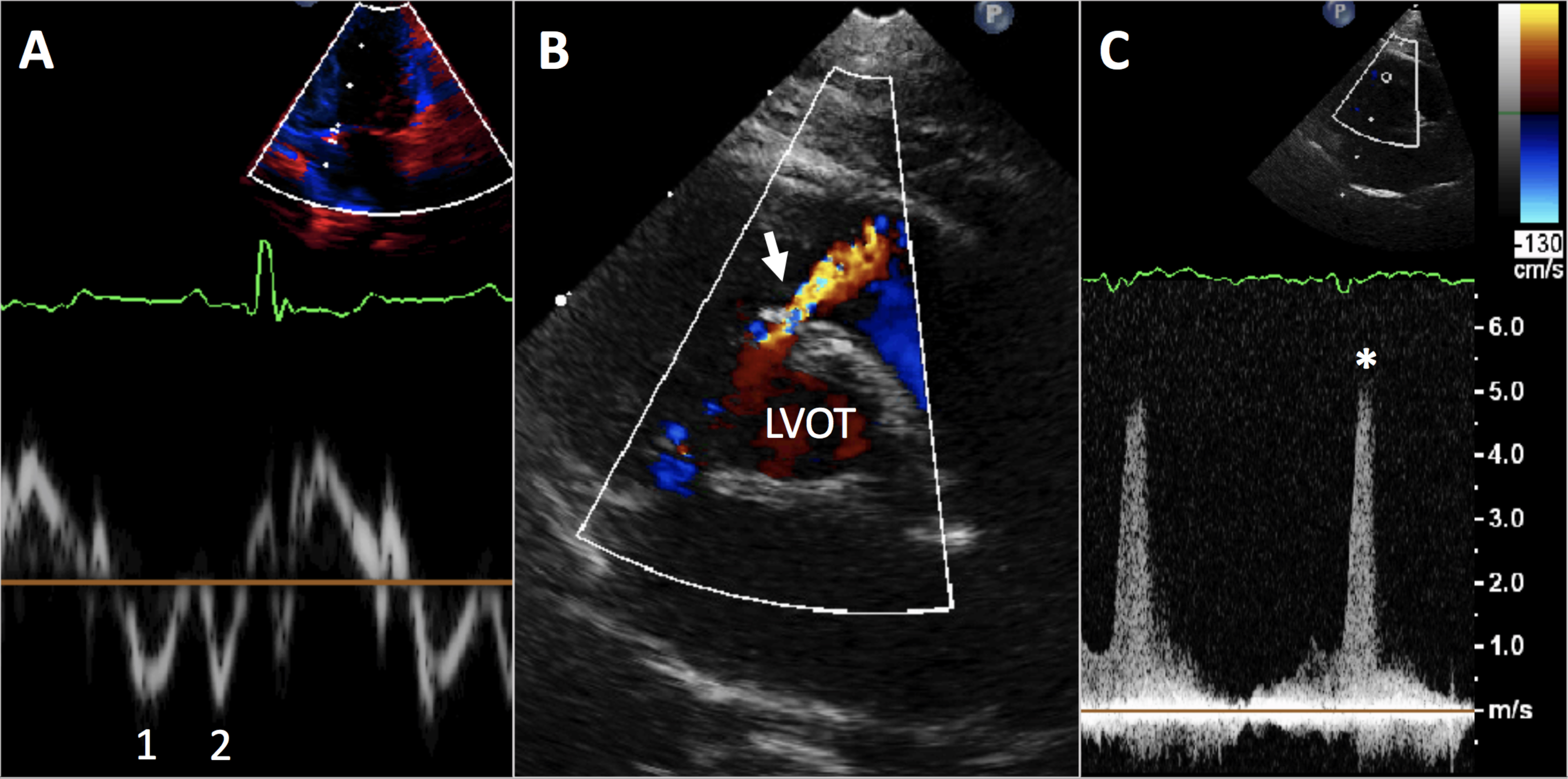 Figure 2: (A) Tissue Doppler assessment of mitral valve annulus shows speed and pattern of annulus motion during systole and diastole. The inverted pattern of the first (1) and second (2) negative spikes below the baseline (spike 1 is less negative than spike 2) suggests impaired left ventricle relaxation. (B) Color Doppler assessment across upper interventricular septum in a cat finds a turbulent color flow Doppler jet (arrow) due to blood flow from the left ventricular outflow tract (LVOT) through a ventricular septal defect. (C) Spectral Doppler waveform () assessment of the ventricular septal defect jet finds shunting velocity that suggests a “restrictive” defect with minimal hemodynamic impact.