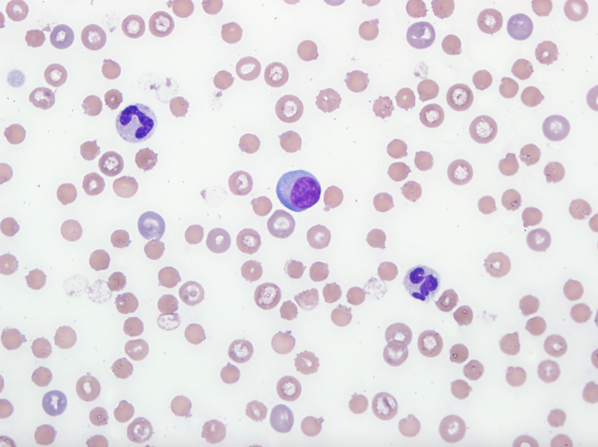 Blood smear showing moderate numbers of Heinz bodies and red blood cell ghosts were seen, indicating Heinz body hemolytic anemia.