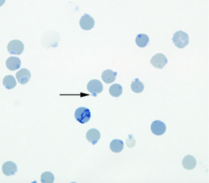 The presence of Heinz bodies was confirmed by staining with new methylene blue.