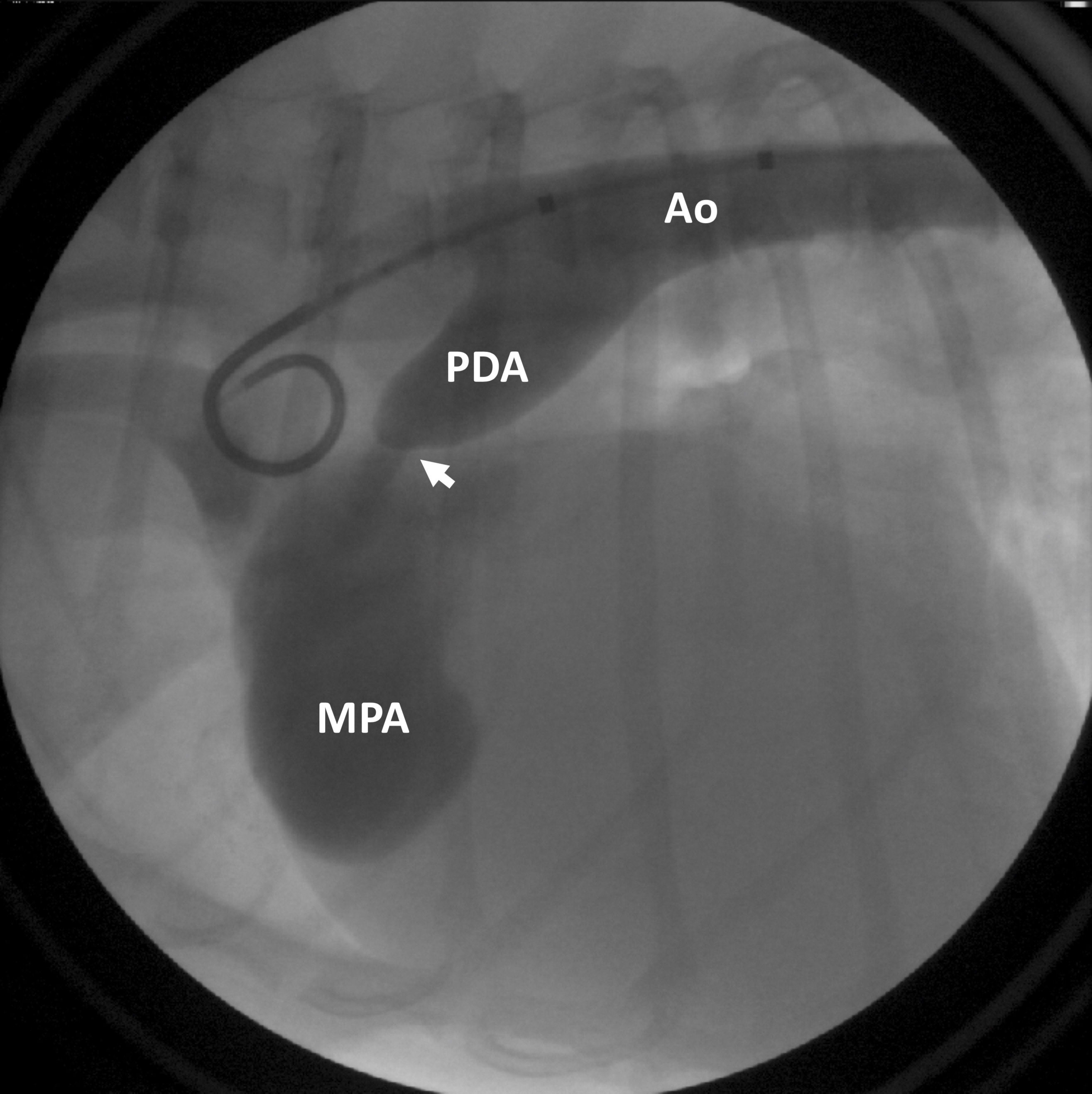 Figure 1: Contrast is injected into the aorta (Ao), highlighting the patent ductus arteriosus (PDA), as well as abnormal blood flow beyond the PDA (arrow) into the main pulmonary artery (MPA).