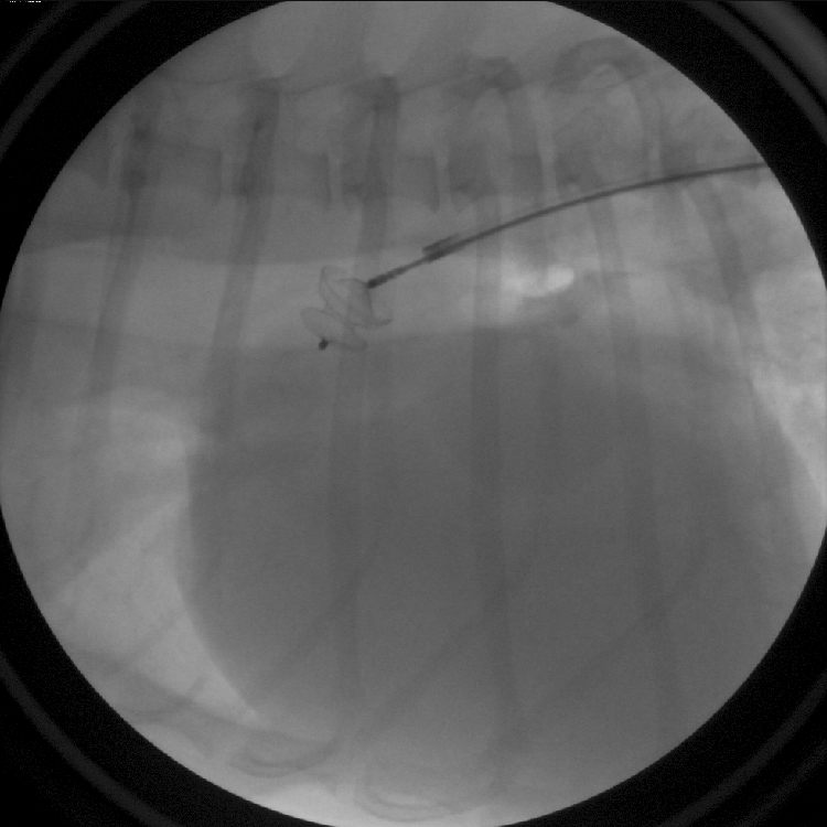 Figure 2: A PDA occlusion device has been placed in the PDA. The device remains connected to the delivery cable and can still be removed from the body if needed.