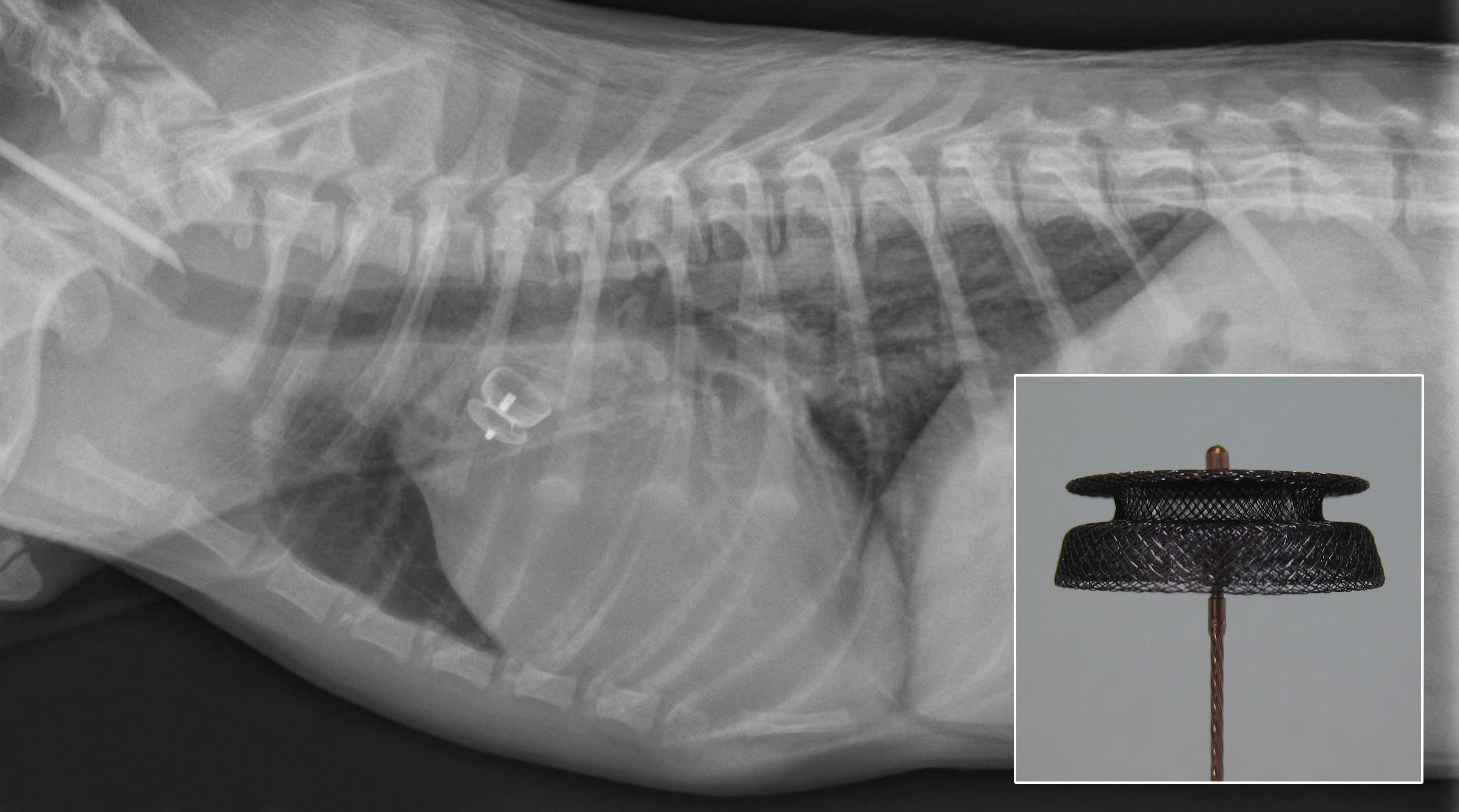 Figure 4: Post-procedure radiograph with appropriately positioned PDA occlusion device. The PDA occlusion device can be seen attached to the delivery cable (inset).