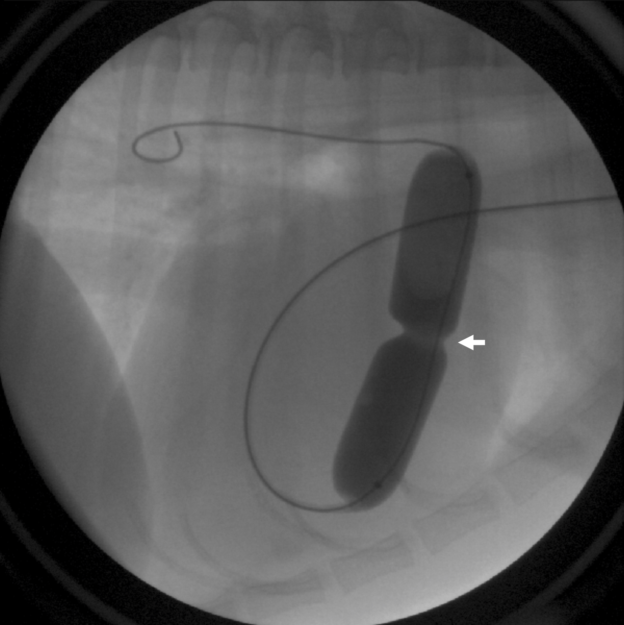 Figure 6: A balloon catheter has been advanced from a vein in the neck, into the right heart, and across the defective valve. The balloon is inflated with diluted contrast, creating an indentation at the level of valve narrowing (arrow) that is subsequently dilated upon full inflation.