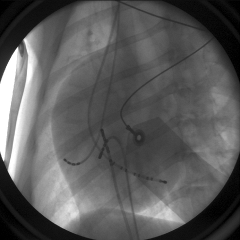 Figure 7: Multielectrode mapping catheters have been placed within the heart as part of an electrophysiologic study.