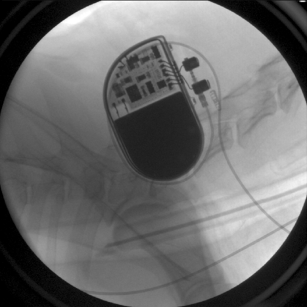 Figure 8: A pacemaker has been placed underneath the skin in front of the shoulder, and it’s lead travels through a vessel in the neck into the heart. 