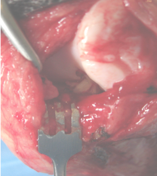 Lateral parapatellar open arthrotomy view of a partially torn left CrCL.  Note the amount of synovitis, entheseophytosis and osteophytosis present in this relatively small partial tear. 