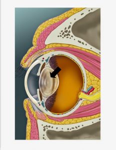 Cataract Surgery in Dogs