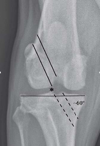 Figure 2 The femoral bone tunnel (solid lines) was started in the origin of the cranial cruciate ligament to exit the lateral metaphyseal cortex at the level of the proximal pole of the lateral fabella. The tibial bone tunnel (dotted lines) was created at the medial aspect of the tibia to exit within the footprint of the cranial cruciate ligament insertion. The desired angle was approximately 60 degrees to the articular surface of the tibia with the lateral edge of the tunnel passing in line with the tip of the lateral spine of the intercondylar eminence (star) in the axial plane (A). Lateral view (B) of femoral (solid lines) and tibial bone tunnels with entrance/exit points (circles).