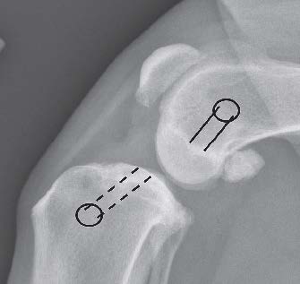 Figure 2B. Lateral view of femoral (solid lines) and tibial bone tunnels with entrance/exit points (circles).