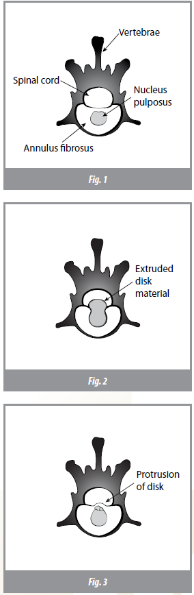 Intervertebral Disk Disease (IVDD) and Treatment in Dogs