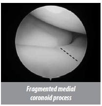 minimally invasive surgery (MIS) for Fragmented medial coronoid process