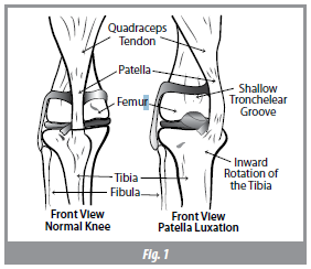 patella-luxation-1