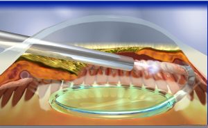 Laser Surgery. Picture of limbal approach ECPC. 