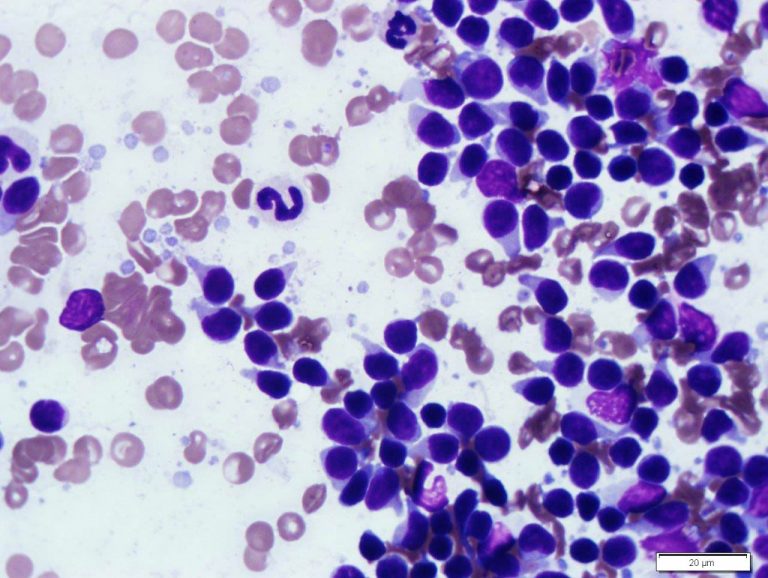 Lymph Node Cytology. 1000X photo from a 9-year-old male golden retriever presented for evaluation of persistent and slowly progressive submandibular and prescapular lymphadenopathy. 