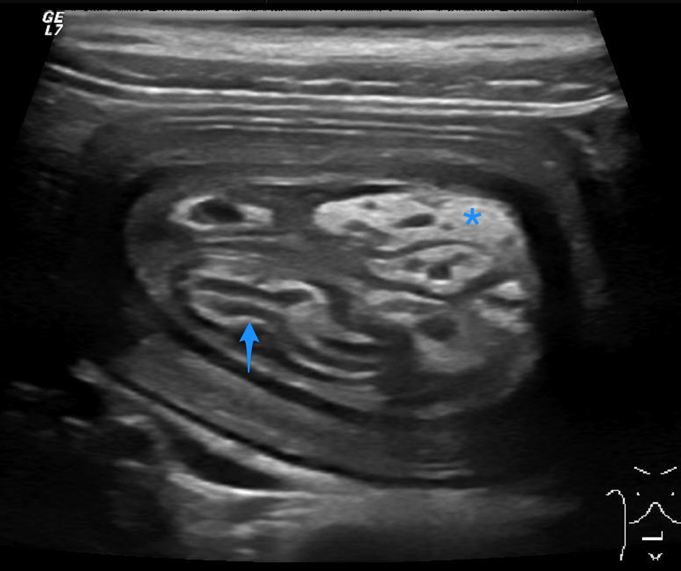 Diagnosing Intussusception with the Meniscus Sign