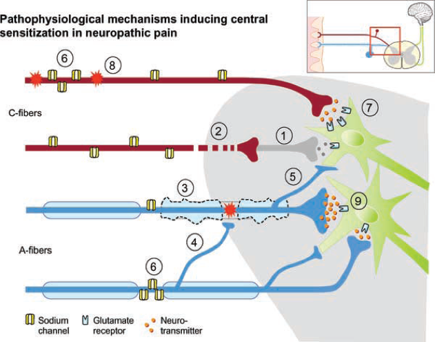 Figure 2 Pathophysiology of C-fiber pain pathway. Gabapentin reduces C-fiber transmission through the dorsal root ganglion (1).