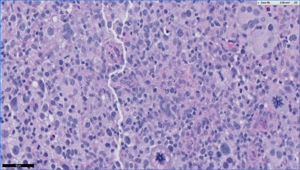 Beagle with Brain Tumor Microscopic description. Photo 4.