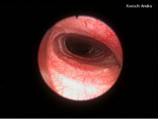 Figure 1. Bronchoscopic view of dynamic tracheal collapse in a Maltese. 