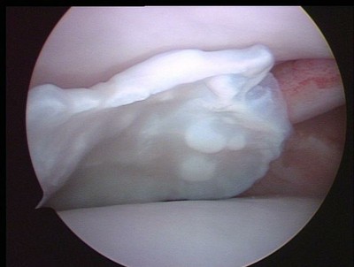 Understanding the Use of Arthroscopy in Dogs. Figure 4. Osteochondritis dissecans (OCD) lesion of the shoulder of a dog.