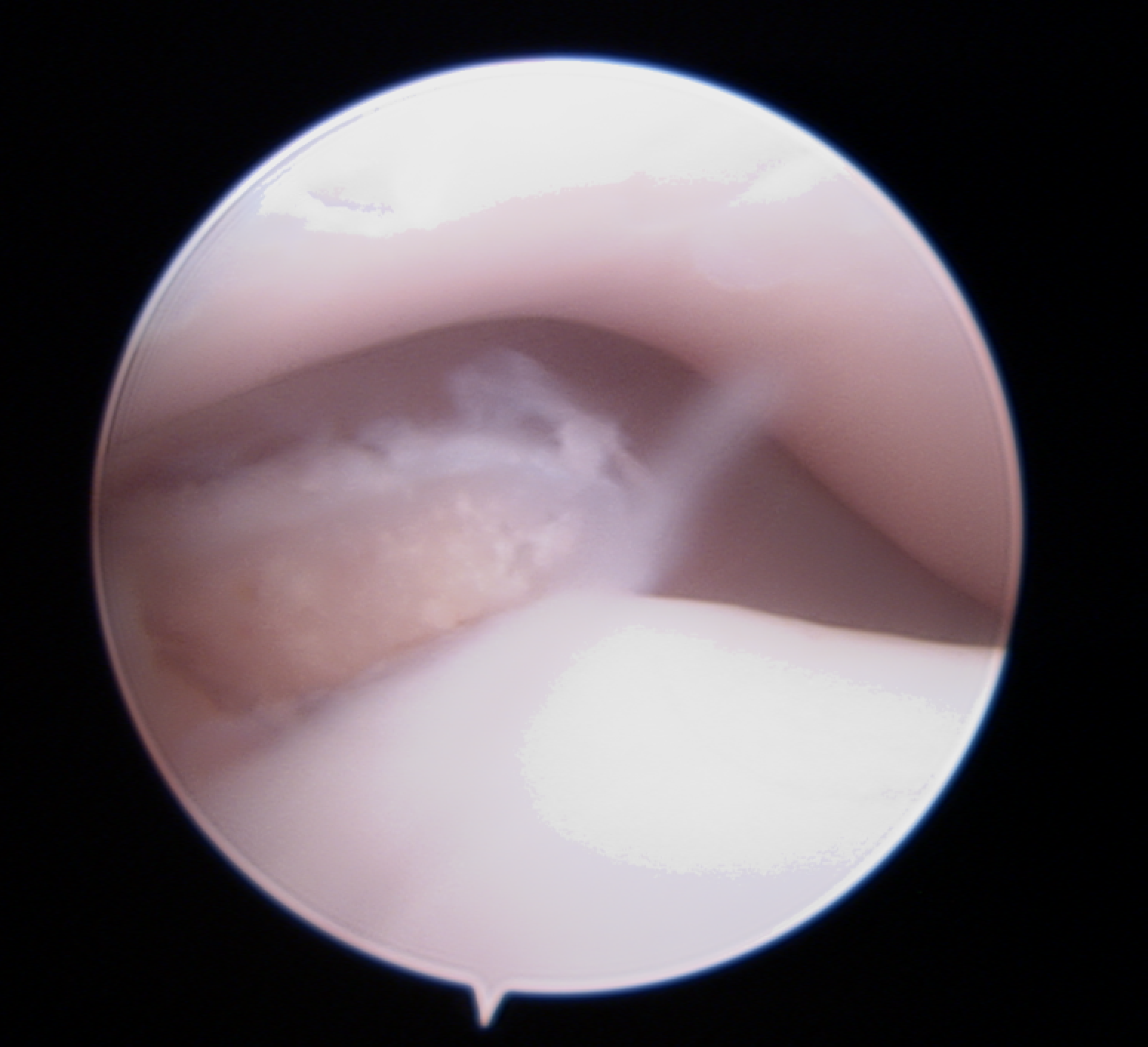 Understanding the Use of Arthroscopy in Dogs. Figure 2. Fragmented coronoid process in a dog. 