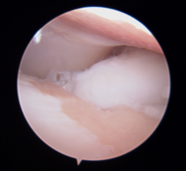 Understanding the Use of Arthroscopy in Dogs. Figure 1. Elbow dysplasia in a dog. Note the cartilage wear (medial compartment disease). 