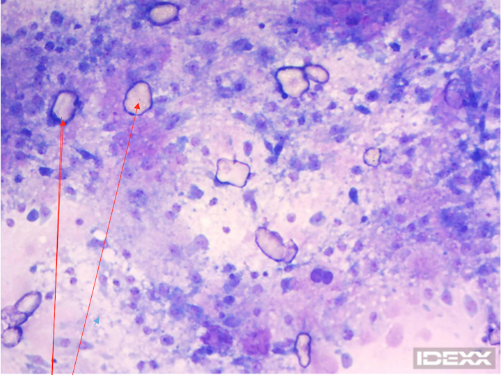 Calcareous corpuscles 100x