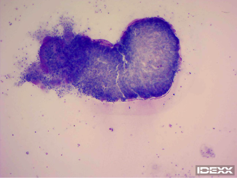 Figure 1. Abdominal fluid cytology. 200X. 