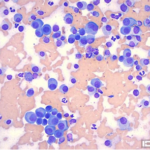 Figure 2. Interdigital mass. 500x magnification, Wright-Giemsa stain.