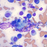 Figure 3. Interdigital mass. 1000x magnification, Wright-Giemsa stain.