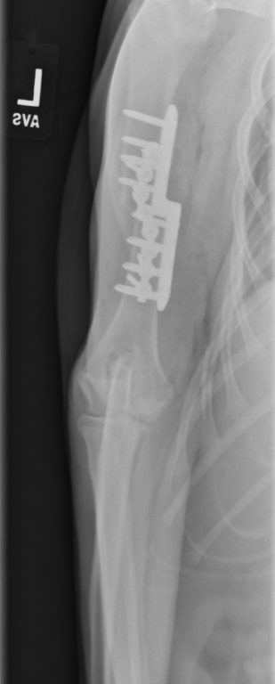 Figure 5. Anterior-posterior (AP) radiograph of the left front leg after sliding humeral osteotomy (SHO).It is also worth noting we find ourselves in the infancy of veterinary regenerative medicine. While anecdotally, therapies such as platelet rich plasma and stem cell therapy show promise, there remains a void of peer reviewed, objective research. At MedVet, these cutting-edge therapy options are available to our patients. We are also participating in various upcoming research to add to the knowledge in the veterinary community. Our experience thus far indicates there is a bright horizon for these new therapies.