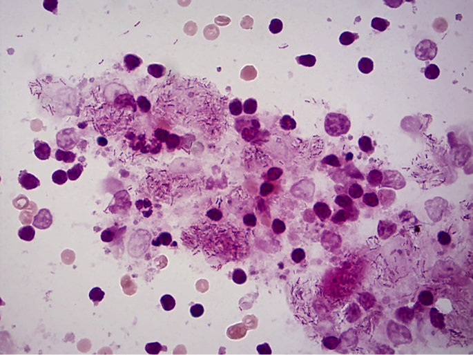 Figure 4. Acid fast stain: showing Acid fast bacilli present. 100x objective.