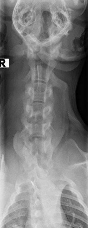 Figure 2. Ventrodorsal radiograph of the spine from a 6-month-old intact male terrier mix with neck pain.