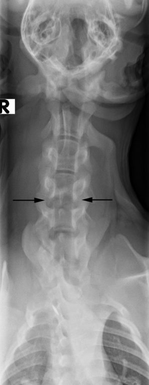 Figure 4. Ventrodorsal radiograph of the spine. Note lucent appearance of the caudal endplate of C4 and the cranial endplate of C5 consistent with the presence of lysis.