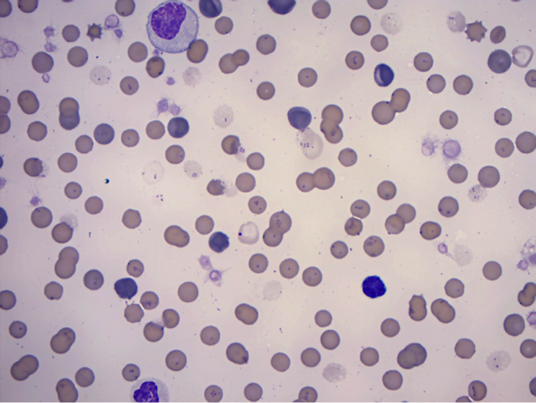 Figure 2. Blood Smear Examination from a 3-year-old anemic cat. 100x Objective.