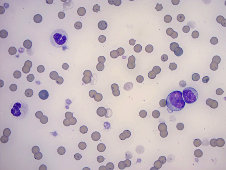 Figure 3. Blood Smear Examination from a 3-year-old anemic cat. 100x Objective.