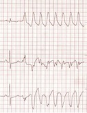 Figure 3. Lead I-III in a dog showing one sinus beat followed by ventricular tachycardia.