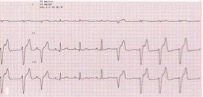 EKG accelerated idioventricular rhythm in a dog 