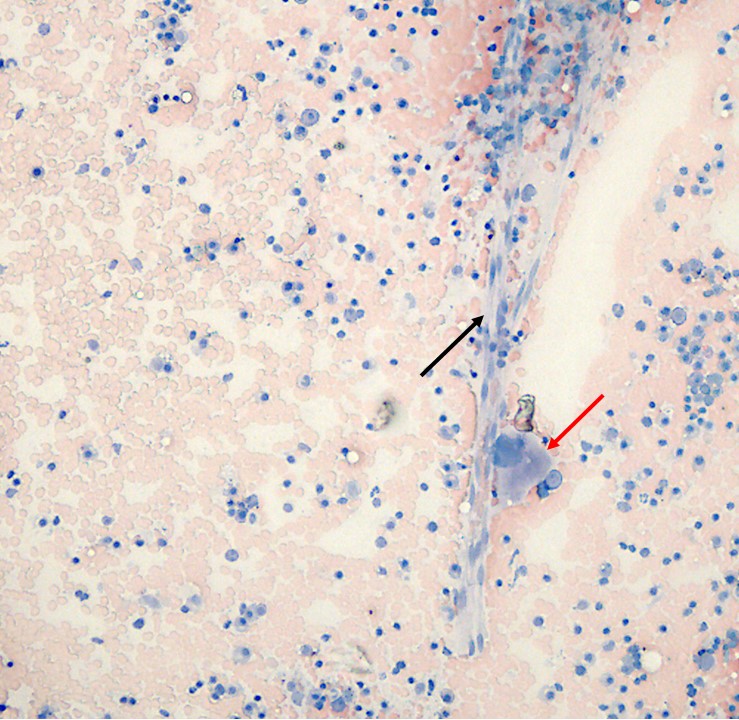 Figure 1. Highly cellular sample containing capillaries (black arrow) and megakaryocytes (red arrow). Wright-Giemsa stain. 100x magnification.