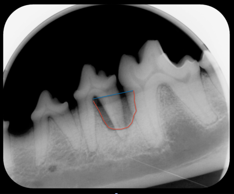 Dental Xray from a dog. Vertical bone loss of the left mandibular fourth premolar and first molar. The blue line illustrates where the alveolar bone should extend too. The red line illustrates the where the bone has receded due to periodontitis. Vertical bone loss may be treated by bone grafting or extraction. 