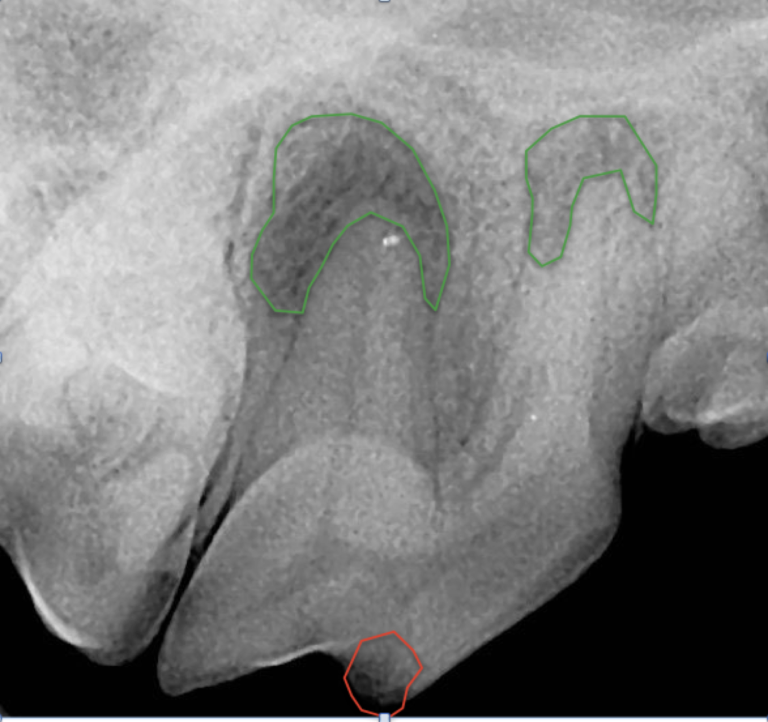 Dental Xray from a dog. Interpretation of figure 2. Periapical lucency of the right maxillary fourth premolar secondary to pulp inflammation. The green circles denote periapical lucency which indicate loss of mineral of the alveolar bone secondary to inflammation. The green circle denotes where the crown was fractured. Note, this fracture did not communicate with the pulp yet still led to disease. 