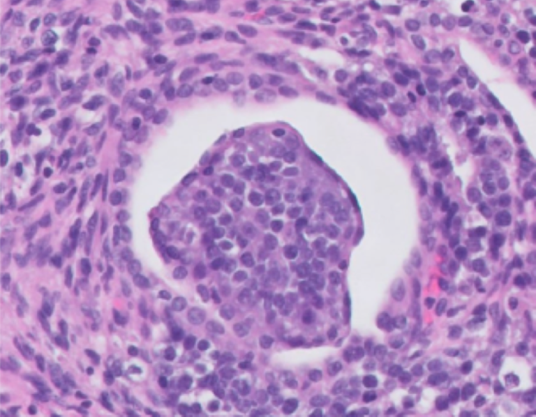 A representative area of the nephroblastoma with a primitive glomerulus in a dog. 